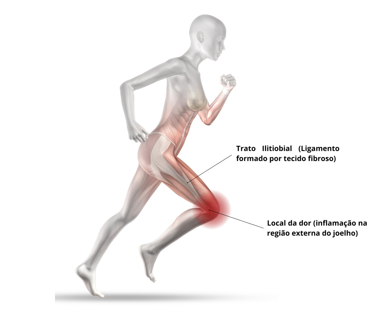 Saiba as causas da Síndrome do Trato Iliotibial Dr Mauro Junior