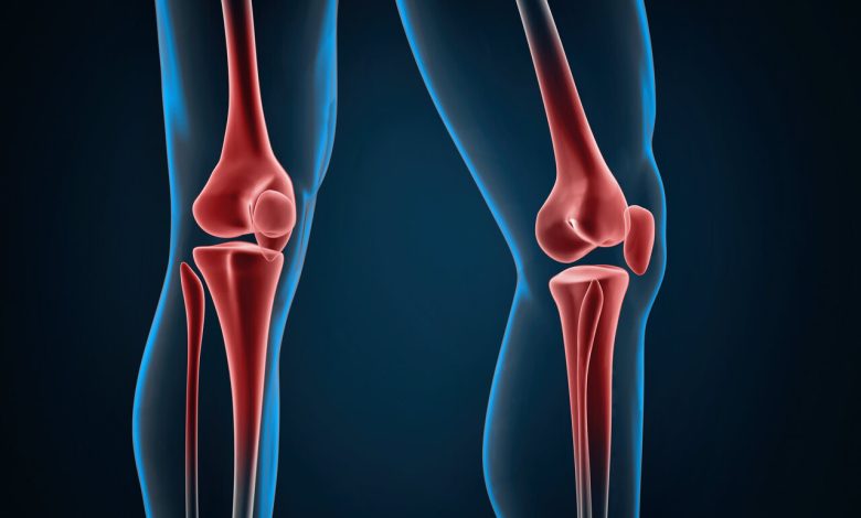Osteotomia de joelho