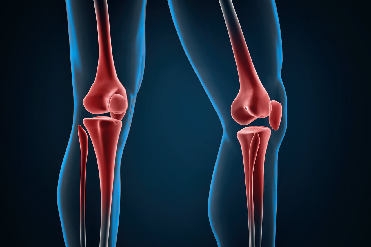 Osteotomia de joelho