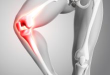 Cirurgia para instabilidade (ou luxação) da patela
