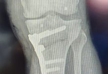 Quando a cirurgia de osteotomia de joelho é indicada?