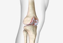Diferença entre a lesão da cartilagem do joelho e artrose do joelho