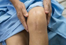 Quais são os riscos de uma cirurgia de prótese de joelho?