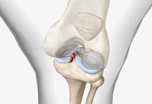 Como saber se sofri uma lesão no menisco do joelho?