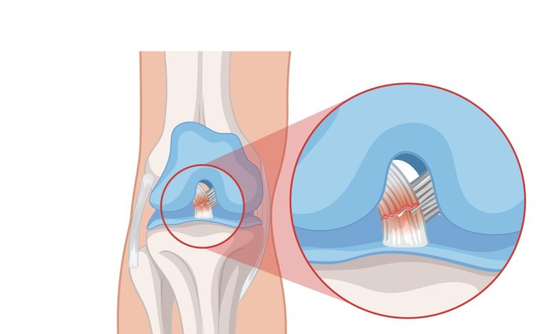 Você sabe que os sintomas podem variar a depender do ligamento dojoelho lesado