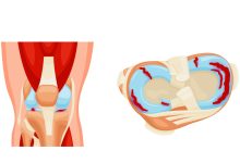 Toda lesão de menisco precisa de cirurgia?