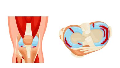 Toda lesão de menisco precisa de cirurgia?