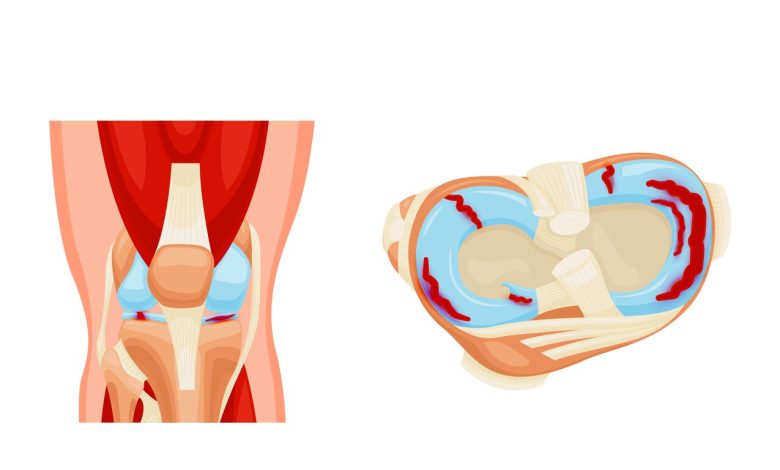 Toda lesão de menisco precisa de cirurgia?