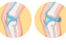 Sensação de joelho estufado. O que pode ser