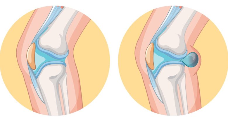 Sensação de joelho estufado. O que pode ser