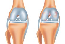 Lesão na cartilagem pode evoluir para artrose?