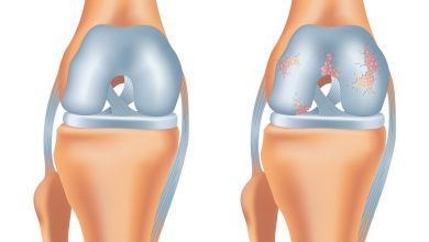 Lesão na cartilagem pode evoluir para artrose?