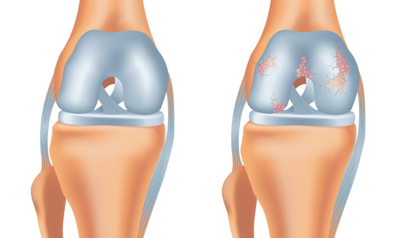 Lesão na cartilagem pode evoluir para artrose?