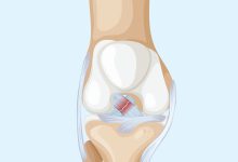 Como identificar uma Lesão no Ligamento Cruzado Anterior (LCA) do joelho?