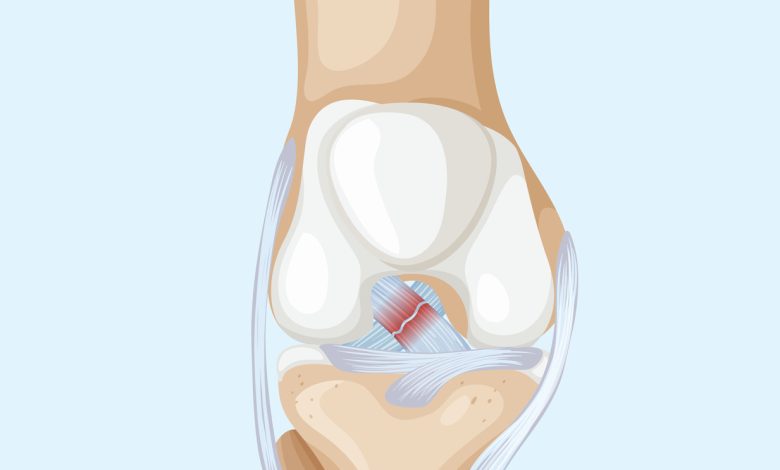 Como identificar uma Lesão no Ligamento Cruzado Anterior (LCA) do joelho?