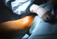 Dicas para se preparar para uma cirurgia de joelho