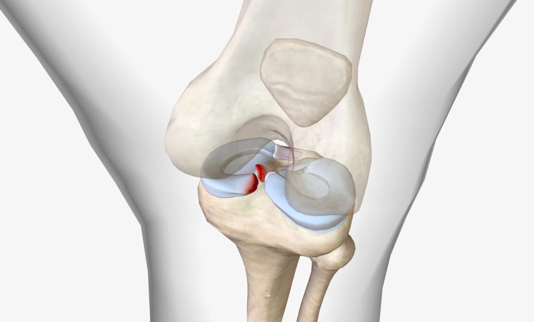 Lesionou o menisco Entenda a diferença entre os tipos de lesão